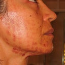 IPL burn marks cheek